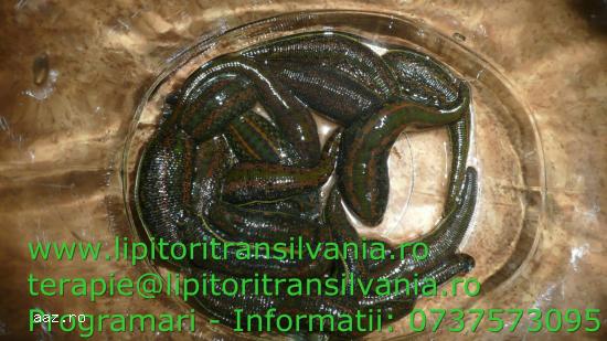 Hirudoterapie - Tratament cu lipitori