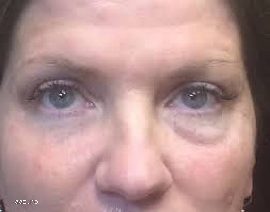 Crema anticearcan antirid cu efect in 3 minute