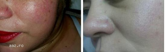 Epilare definitiva Pitesti Laser Dioda