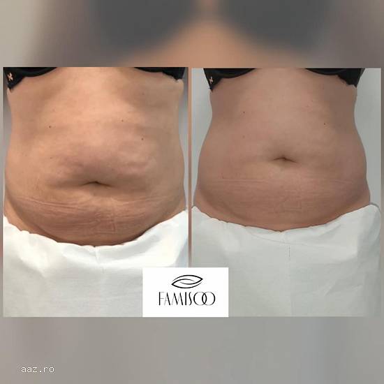 LIPOSONIX - tratament slabire