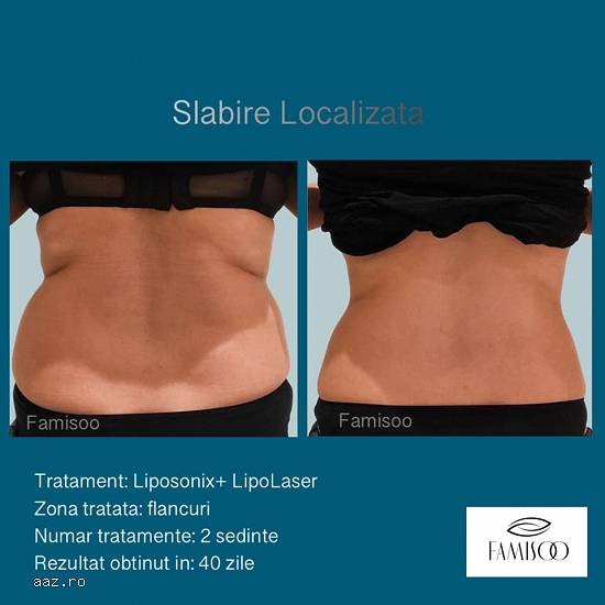 LIPOSONIX - tratament slabire