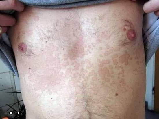 Pitiriazis VERSICOLOR |Tratament naturist #bio #vegan