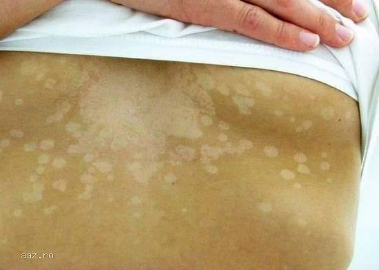 Pitiriazis VERSICOLOR |Tratament naturist #bio #vegan