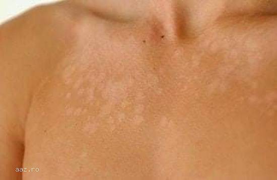 Pitiriazis VERSICOLOR |Tratament naturist #bio #vegan