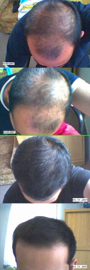 Tratament Minoxidil 5% impotriva caderii parului KIRKLAND produs SUA