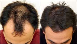 Tratament Minoxidil 5% impotriva caderii parului KIRKLAND produs SUA