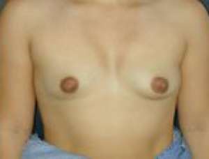 Implant Mamar, Marire Sani, Implanturi Mamare