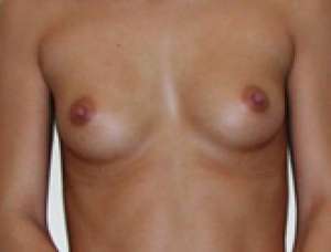 Implant Mamar, Marire Sani, Implanturi Mamare