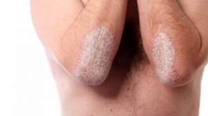 CRIOSAUNA - element de baza in terapia multimodala a PSORIAZISULUI